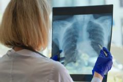 Dois novos casos de câncer de pulmão são diagnosticados no Hospital das Clínicas de Botucatu,  semanalmente